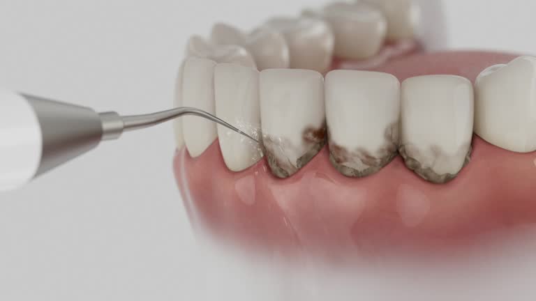 Trusted Wisdom Tooth Removal service in Temecula, CA - Dentist Open Now